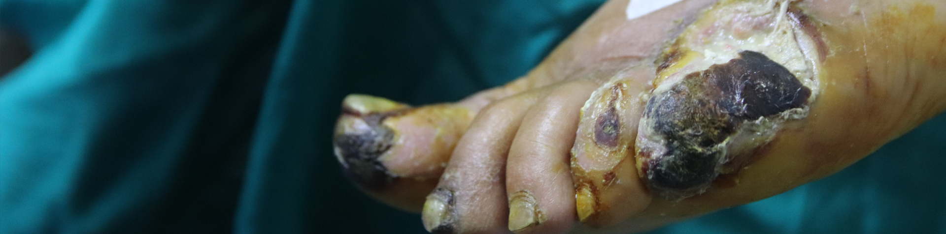 FootCare Diabetic Woundcare